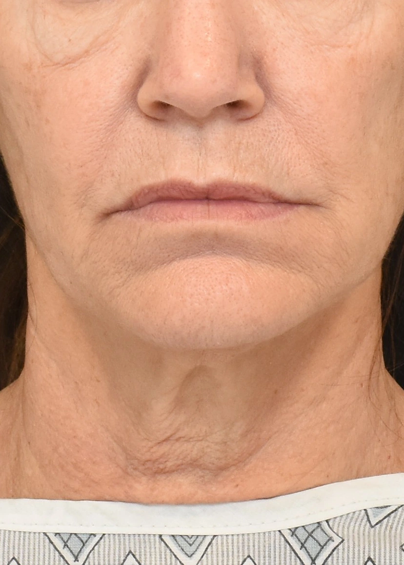 Deep Plane Facelift Patient 37 Set 1 Before