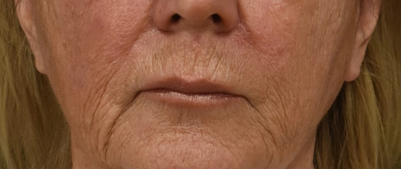 Lip Lift Patient 1 Set 1 Before